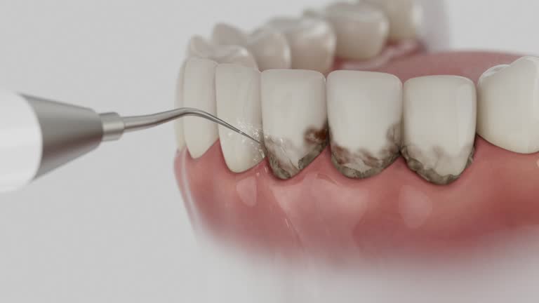 Reliable Dental Implants contractor in Lacombe, LA by Smile Center Dentistry